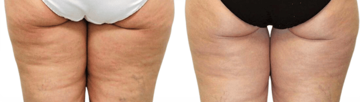 London's most popular non-surgical body contouring treatment