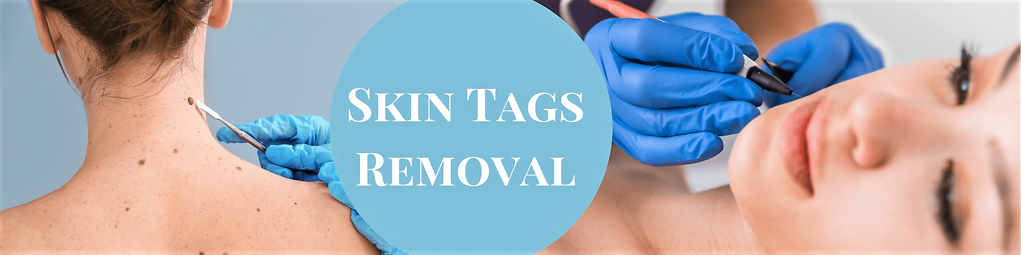 Skin tags removal treatment on the face and body